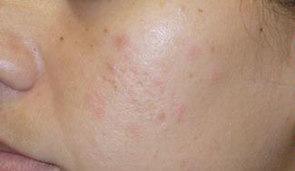 Cicatrices del acne-Es posible su tratamiento desde dentro